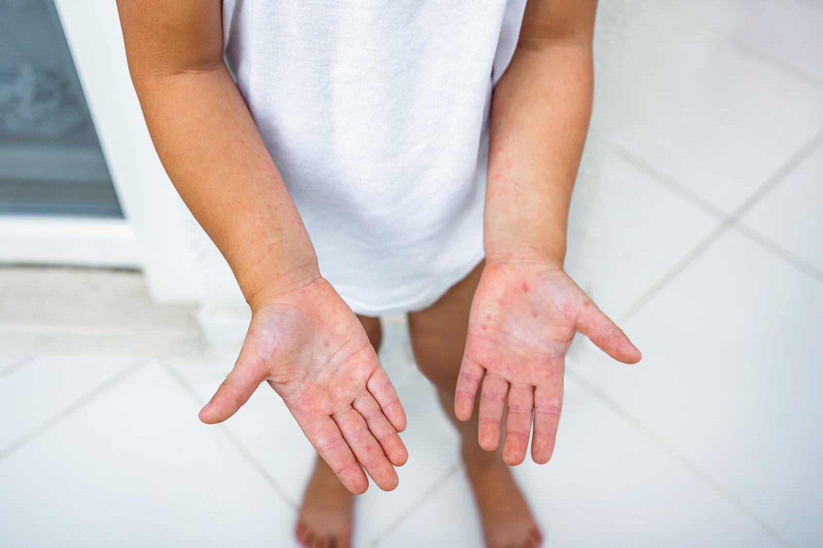 Eczema relief cupping therapy