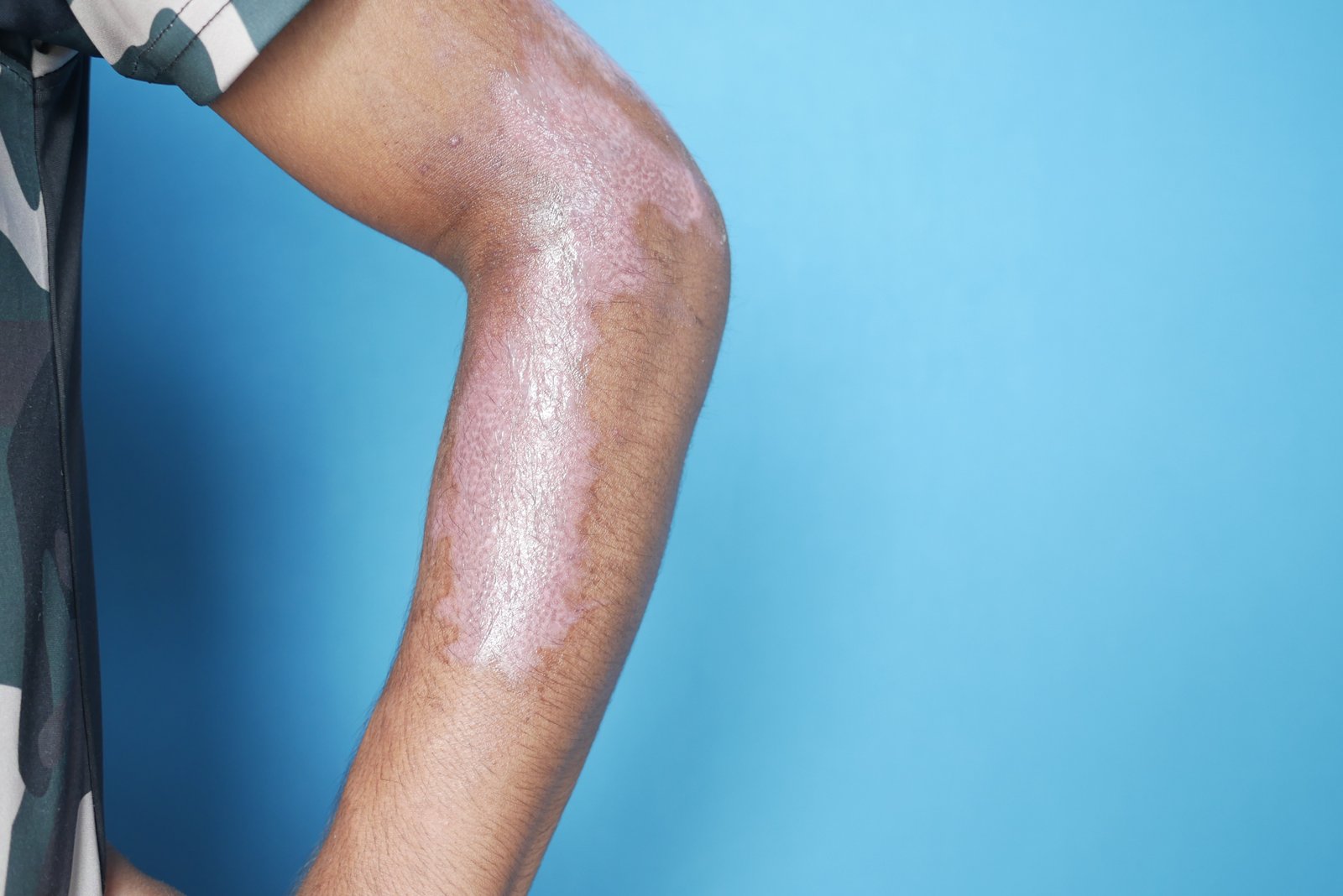 Doctor consulting patient for eczema